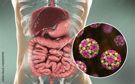 was ist norovirus infektion